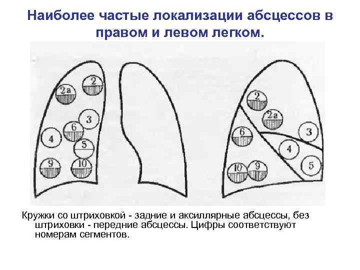 Абсцесс легкого клинические