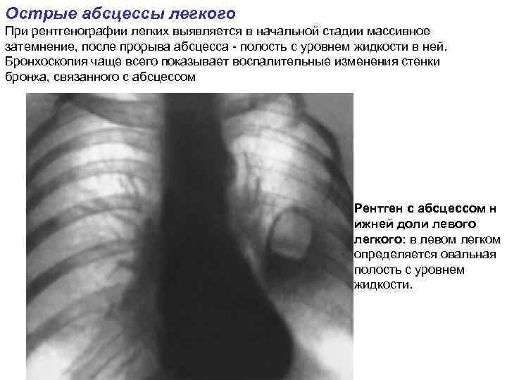 Абсцесс легкого фото