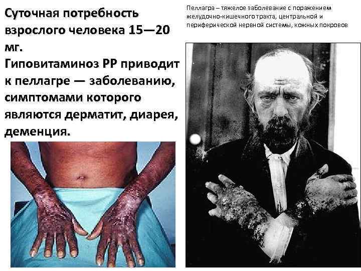 Суточная потребность взрослого человека 15— 20 мг. Гиповитаминоз РР приводит к пеллагре — заболеванию,
