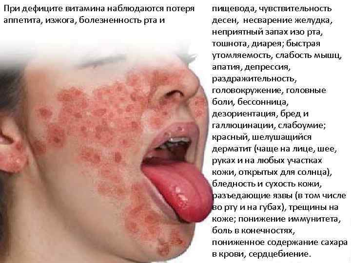 При дефиците витамина наблюдаются потеря аппетита, изжога, болезненность рта и пищевода, чувствительность десен, несварение