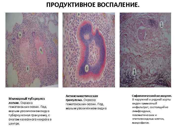 ПРОДУКТИВНОЕ ВОСПАЛЕНИЕ. Милиарный туберкулез легких. Окраска гематоксилин-эозин. Под малым увеличением видна туберкулезная гранулема, с