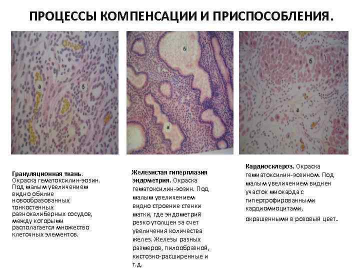 ПРОЦЕССЫ КОМПЕНСАЦИИ И ПРИСПОСОБЛЕНИЯ. Грануляционная ткань. Окраска гематоксилин-эозин. Под малым увеличением видно обилие новообразованных