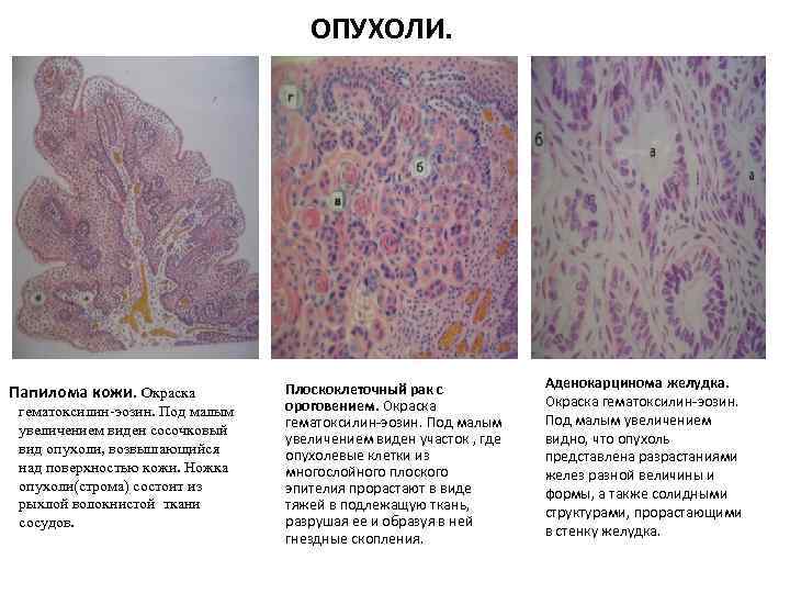 ОПУХОЛИ. Папилома кожи. Окраска гематоксилин-эозин. Под малым увеличением виден сосочковый вид опухоли, возвышающийся над