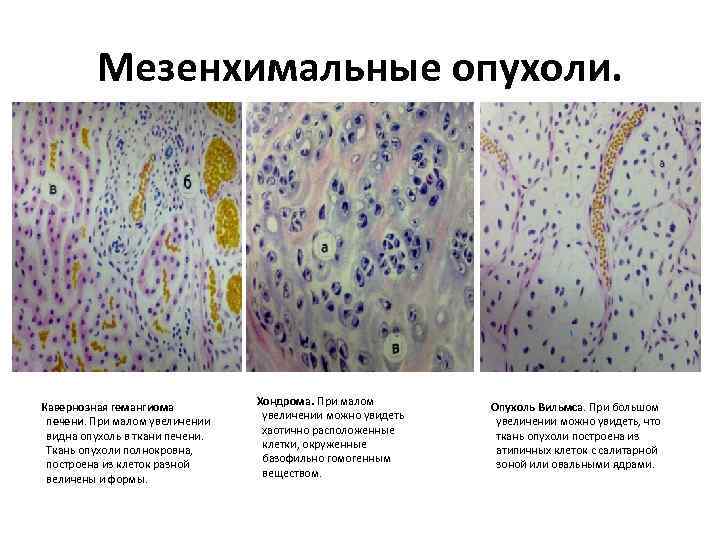 Мезенхимальные опухоли. Кавернозная гемангиома печени. При малом увеличении видна опухоль в ткани печени. Ткань