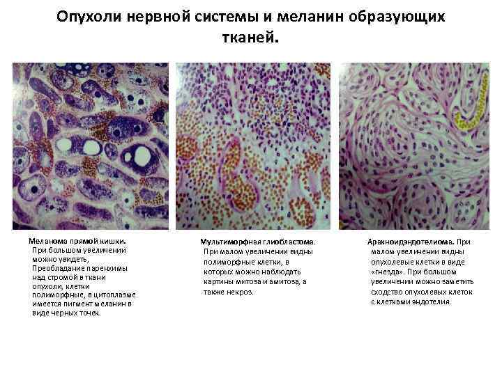 Опухоли нервной системы и меланин образующих тканей. Меланома прямой кишки. При большом увеличении можно