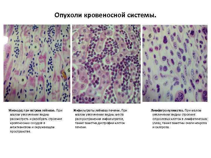 Опухоли кровеносной системы. Миокард при остром лейкозе. При малом увеличении видны рассмотреть и разобрать