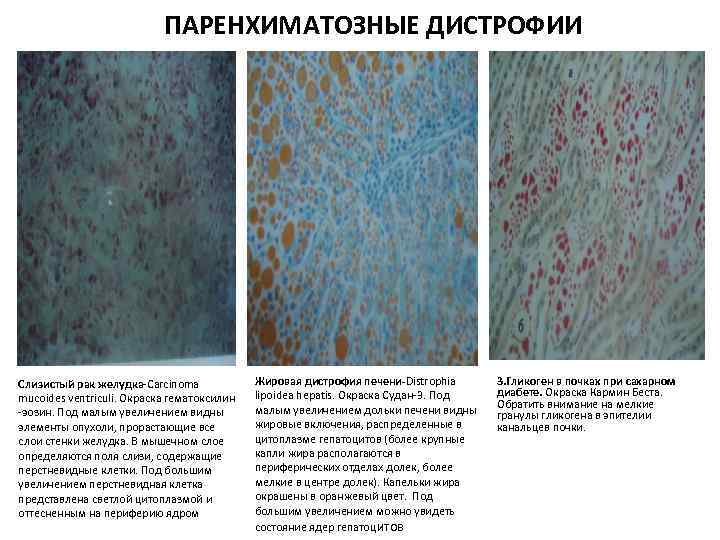  ПАРЕНХИМАТОЗНЫЕ ДИСТРОФИИ Слизистый рак желудка-Carcinoma mucoides ventriculi. Окраска гематоксилин -эозин. Под малым увеличением