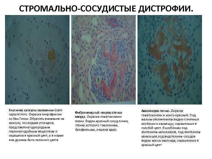  СТРОМАЛЬНО-СОСУДИСТЫЕ ДИСТРОФИИ. Гиалиноз капсулы селезенки-Gialin capsule liens. Окраска пикрофуксин по Ван Гизон. Обратить