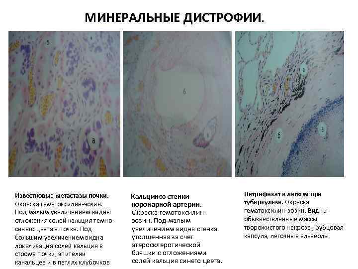 МИНЕРАЛЬНЫЕ ДИСТРОФИИ. Известковые метастазы почки. Кальциноз стенки Окраска гематоксилин-эозин. коронарной артерии. Под малым увеличением