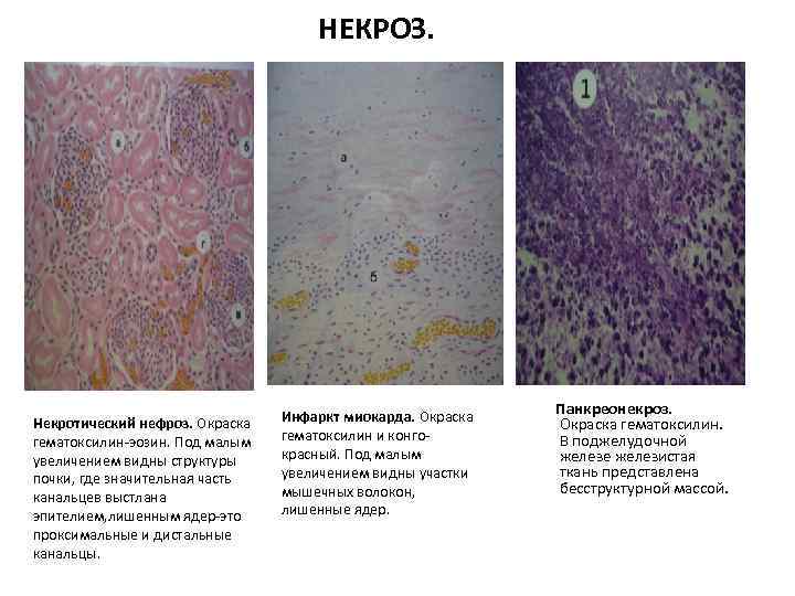  НЕКРОЗ. Некротический нефроз. Окраска гематоксилин-эозин. Под малым увеличением видны структуры почки, где значительная