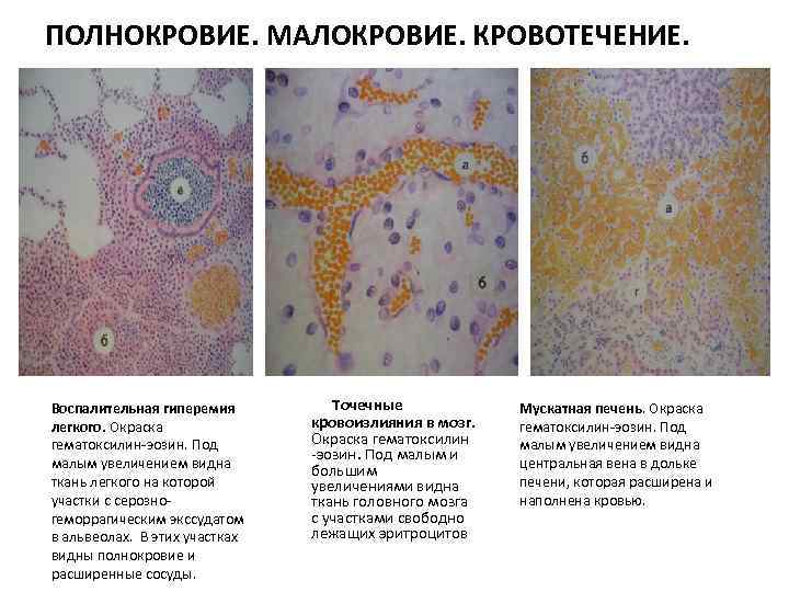 ПОЛНОКРОВИЕ. МАЛОКРОВИЕ. КРОВОТЕЧЕНИЕ. Воспалительная гиперемия легкого. Окраска гематоксилин-эозин. Под малым увеличением видна ткань легкого