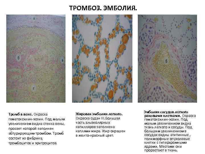 ТРОМБОЗ. ЭМБОЛИЯ. Тромб в вене. Окраска гематоксилин-эозин. Под малым увеличением видна стенка вены, просвет