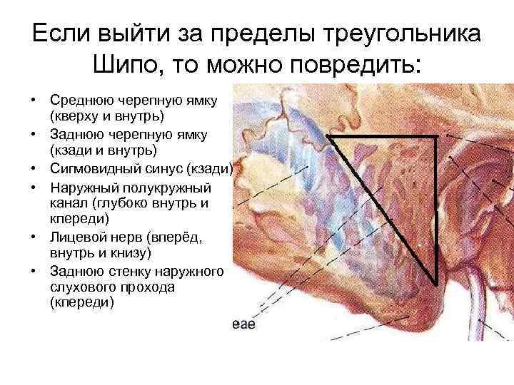 Если выйти за пределы треугольника Шипо, то можно повредить: • Среднюю черепную ямку (кверху