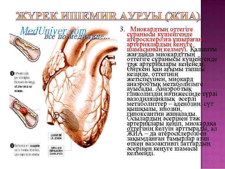 3. Миокардтың оттегіге сұранысы күшейгенде атеросклерозға ұшыраған артериялардың кеңуге шамасының келмеуі. Қалыпты жағдайда миокардттың