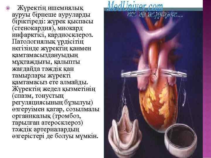  Жүректің ишемиялық ауруы бірнеше ауруларды біріктіреді: жүрек қыспасы (стенокардия), миокард инфарктісі, кардиосклероз. Патологиялық