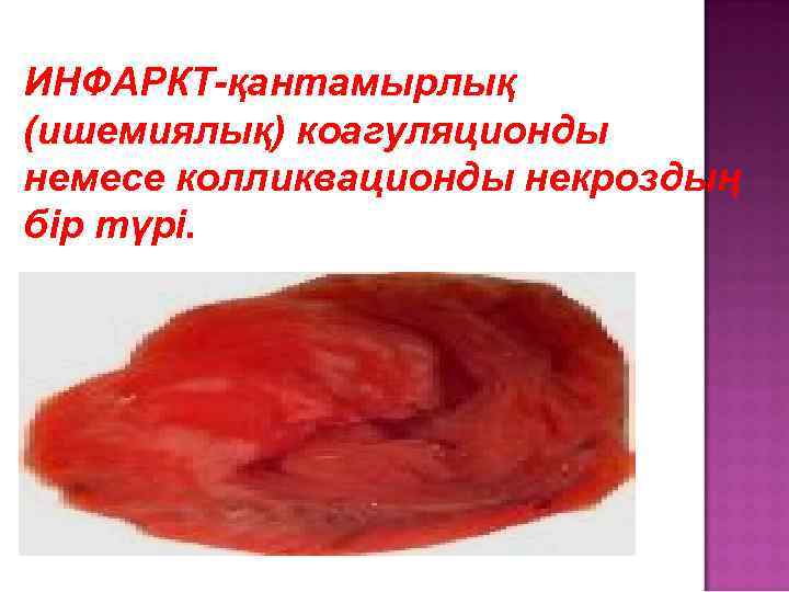 ИНФАРКТ-қантамырлық (ишемиялық) коагуляционды немесе колликвационды некроздың бір түрі. 
