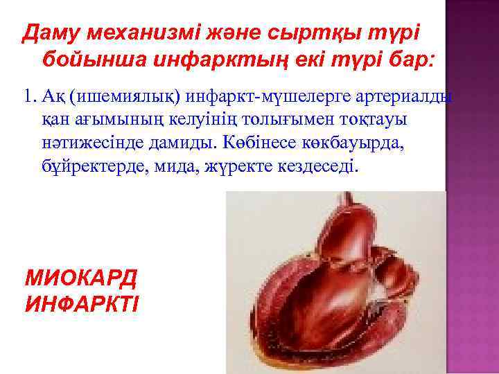 Даму механизмі және сыртқы түрі бойынша инфарктың екі түрі бар: 1. Ақ (ишемиялық) инфаркт-мүшелерге