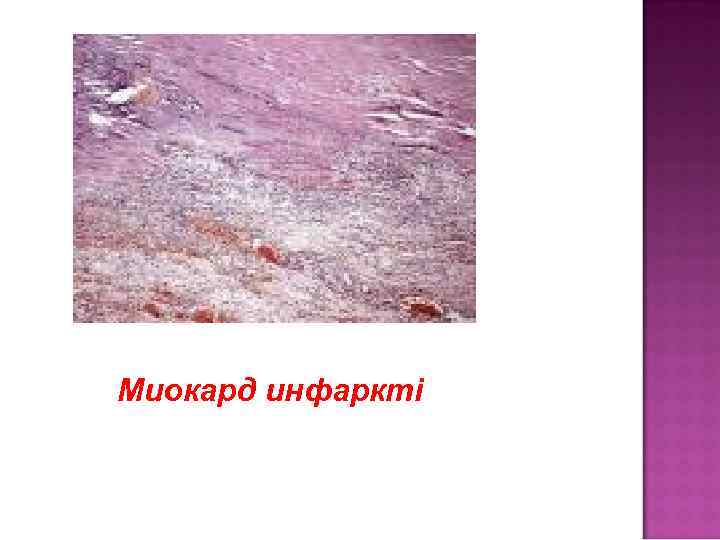 Миокард инфаркті 