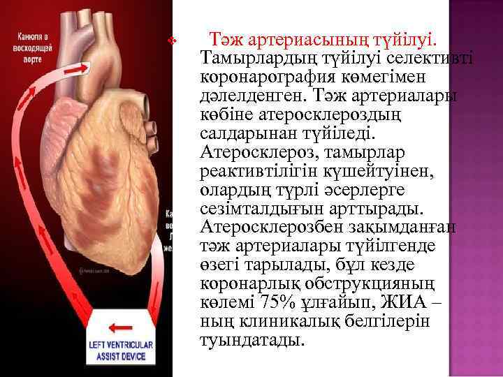 v Тәж артериасының түйілуі. Тамырлардың түйілуі селективті коронарография көмегімен дәлелденген. Тәж артериалары көбіне атеросклероздың