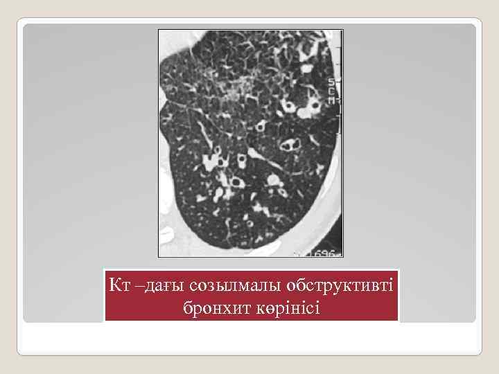 Кт –дағы созылмалы обструктивті бронхит көрінісі 