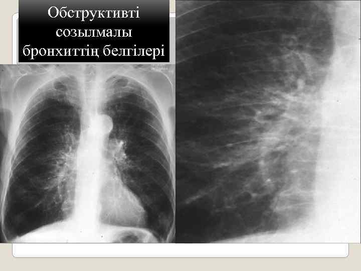 Обструктивті созылмалы бронхиттің белгілері 