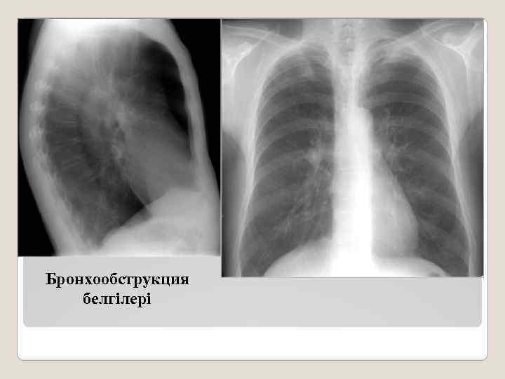 Бронхообструкция белгілері 