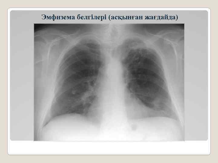 Эмфизема белгілері (асқынған жағдайда) 