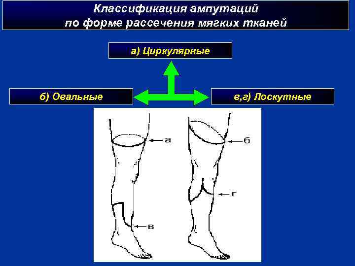 Классификация ампутаций по форме рассечения мягких тканей а) Циркулярные б) Овальные в, г) Лоскутные