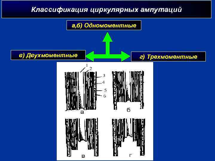 Классификация циркулярных ампутаций а, б) Одномоментные в) Двухмоментные г) Трехмоментные 