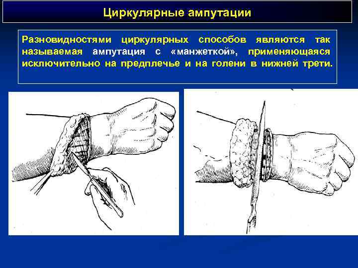 Циркулярные ампутации Разновидностями циркулярных способов являются так называемая ампутация с «манжеткой» , применяющаяся исключительно