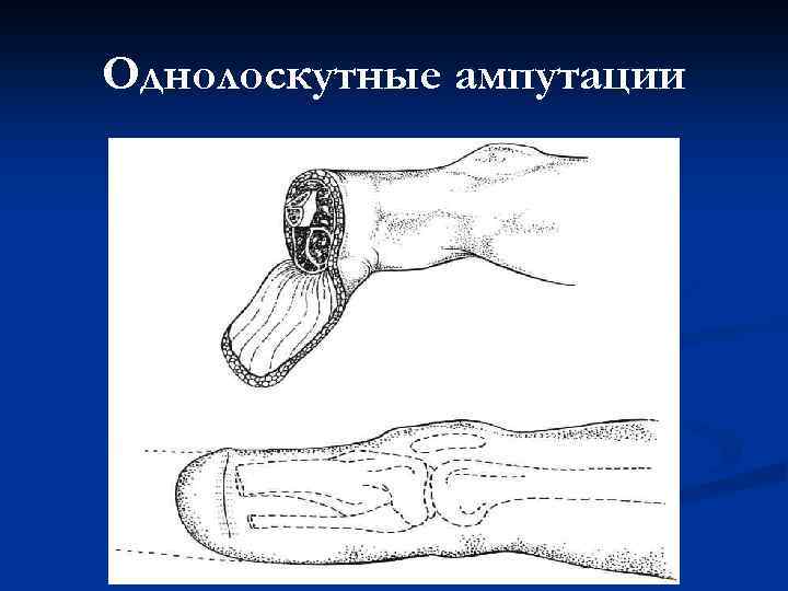 Однолоскутные ампутации 