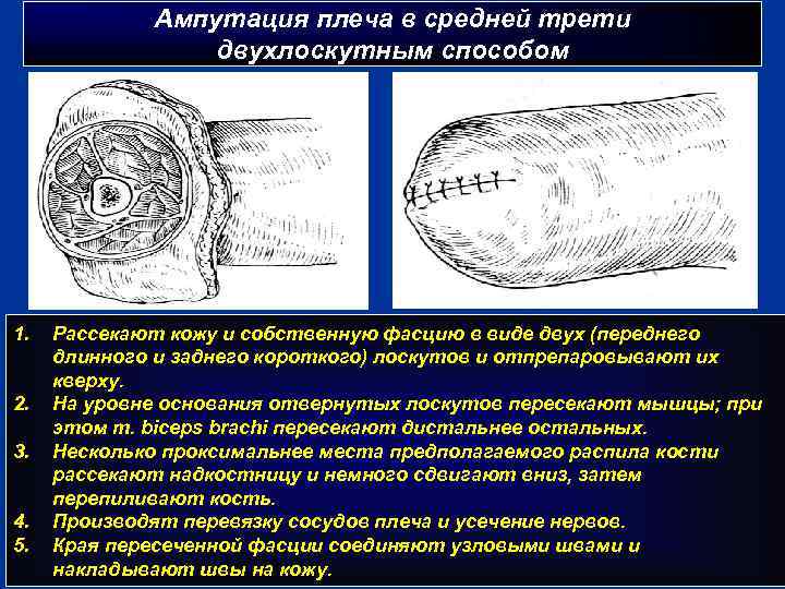 Ампутация плеча в средней трети двухлоскутным способом 1. 2. 3. 4. 5. Рассекают кожу