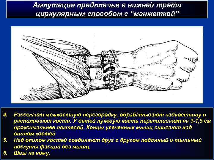 Ампутация предплечья в нижней трети циркулярным способом с “манжеткой” 4. 5. 6. Рассекают межкостную