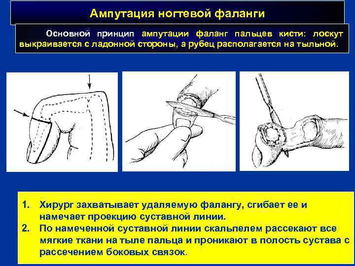 Ампутация ногтевой фаланги Основной принцип ампутации фаланг пальцев кисти: лоскут выкраивается с ладонной стороны,