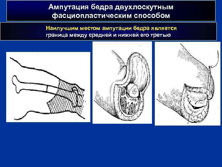 Ампутация бедра двухлоскутным фасциопластическим способом Наилучшим местом ампутации бедра является граница между средней и