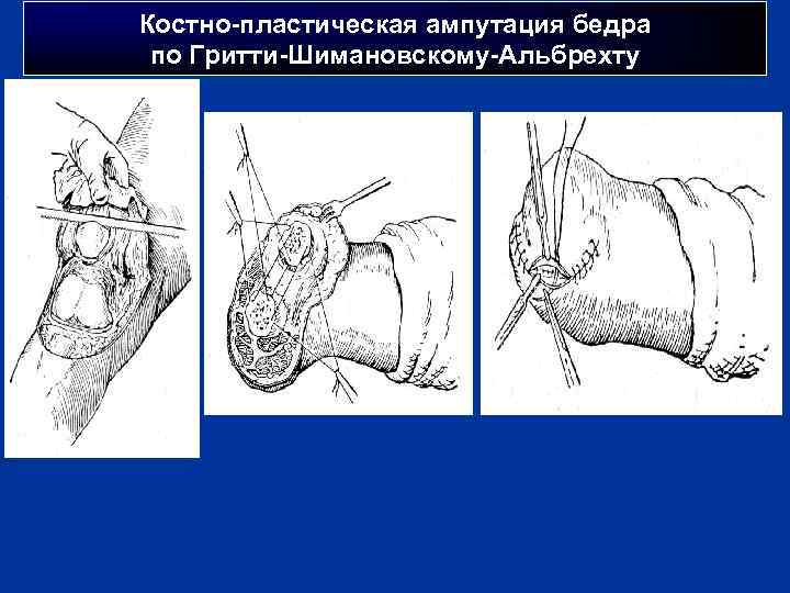 Костно-пластическая ампутация бедра по Гритти-Шимановскому-Альбрехту 