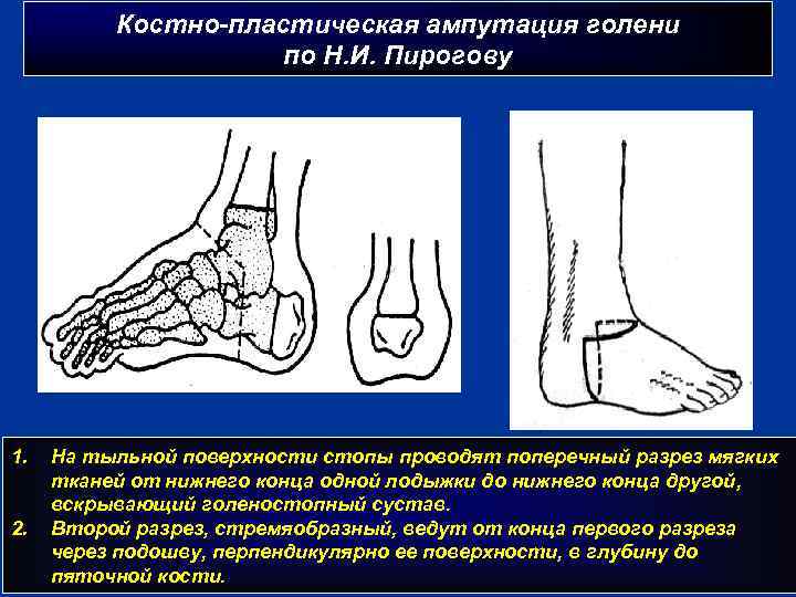 Костно-пластическая ампутация голени по Н. И. Пирогову 1. 2. На тыльной поверхности стопы проводят