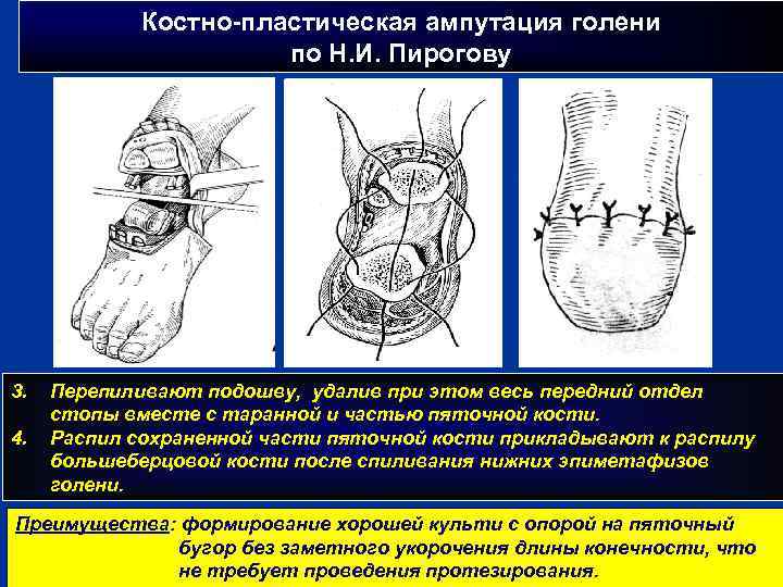 Костно-пластическая ампутация голени по Н. И. Пирогову 3. 4. Перепиливают подошву, удалив при этом