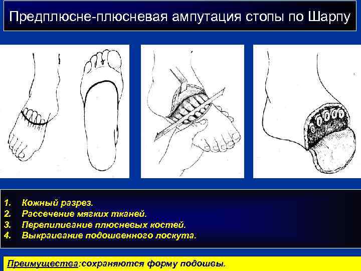 Предплюсне-плюсневая ампутация стопы по Шарпу 1. 2. 3. 4. Кожный разрез. Рассечение мягких тканей.