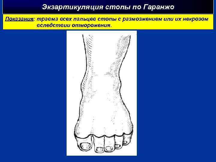 Экзартикуляция стопы по Гаранжо Показания: травма всех пальцев стопы с размозжением или их некрозом