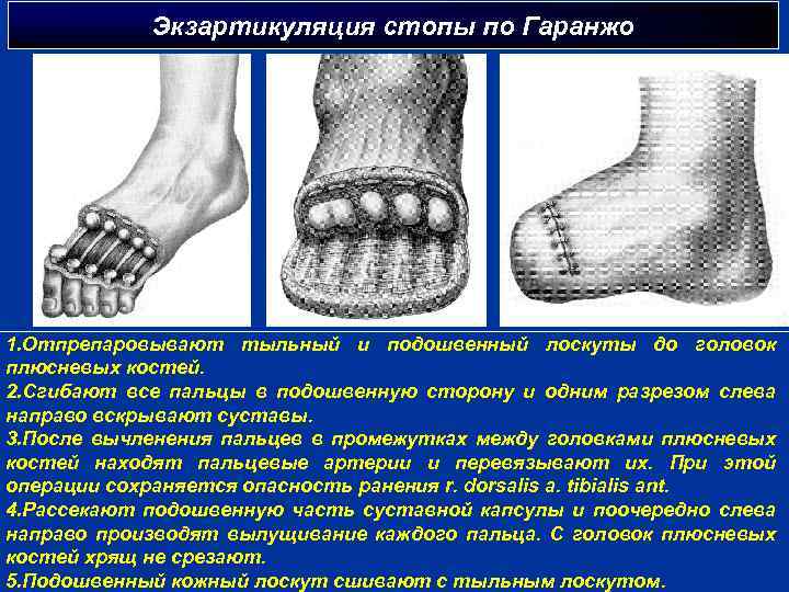 Экзартикуляция стопы по Гаранжо 1. Отпрепаровывают тыльный и подошвенный лоскуты до головок плюсневых костей.