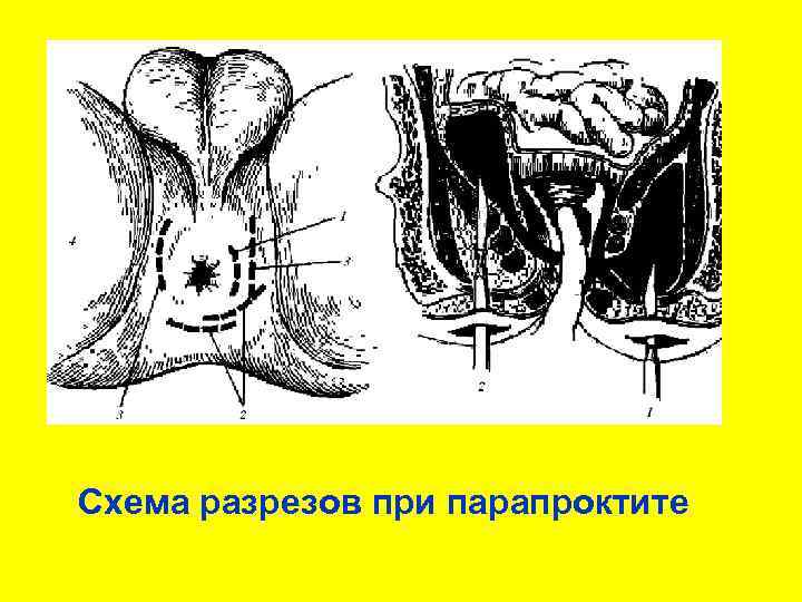 Схема разрезов при парапроктите 