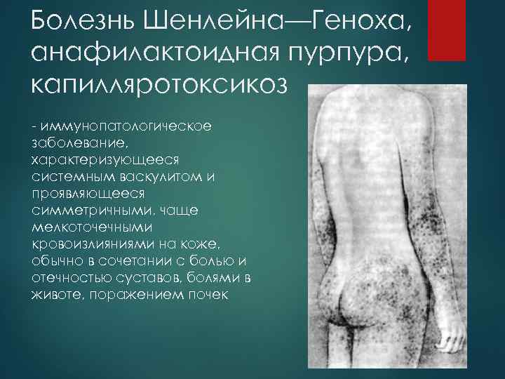 Болезнь Шенлейна—Геноха, анафилактоидная пурпура, капилляротоксикоз - иммунопатологическое заболевание, характеризующееся системным васкулитом и проявляющееся симметричными,