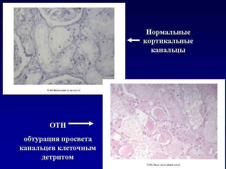 Нормальные кортикальные канальцы ОТН обтурация просвета канальцев клеточным детритом 