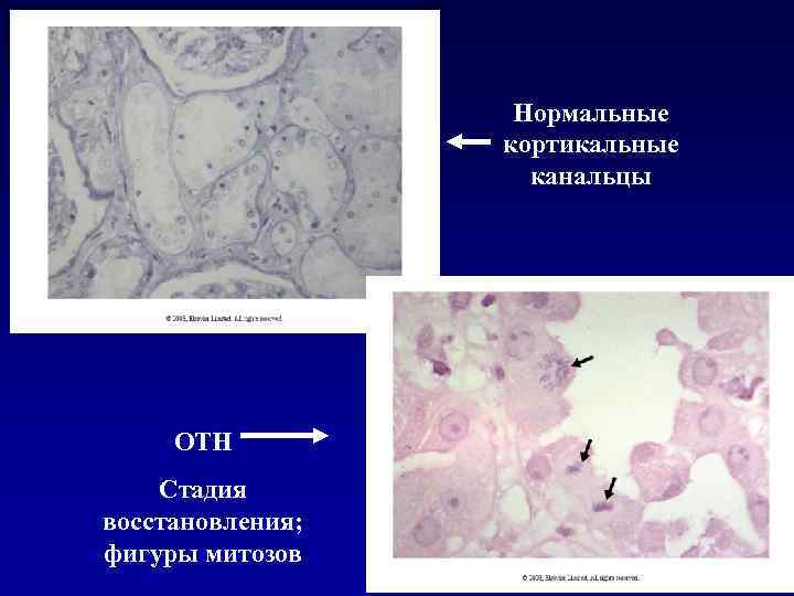 Нормальные кортикальные канальцы ОТН Стадия восстановления; фигуры митозов 
