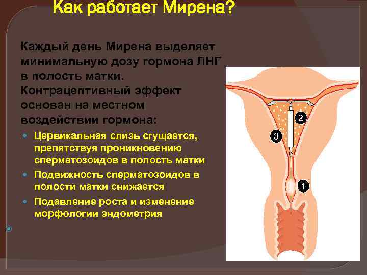 Как работает Мирена? Каждый день Мирена выделяет минимальную дозу гормона ЛНГ в полость матки.