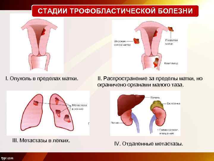 СТАДИИ ТРОФОБЛАСТИЧЕСКОЙ БОЛЕЗНИ I. Опухоль в пределах матки. III. Метастазы в легких. II. Распространение