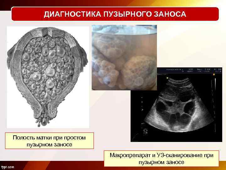 ДИАГНОСТИКА ПУЗЫРНОГО ЗАНОСА Полость матки простом пузырном заносе Макропрепарат и УЗ-сканирование при пузырном заносе