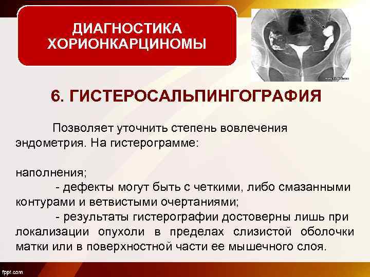 ДИАГНОСТИКА ХОРИОНКАРЦИНОМЫ 6. ГИСТЕРОСАЛЬПИНГОГРАФИЯ Позволяет уточнить степень вовлечения эндометрия. На гистерограмме: наполнения; - дефекты