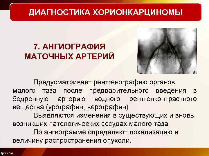 ДИАГНОСТИКА ХОРИОНКАРЦИНОМЫ 7. АНГИОГРАФИЯ МАТОЧНЫХ АРТЕРИЙ Предусматривает рентгенографию органов малого таза после предварительного введения